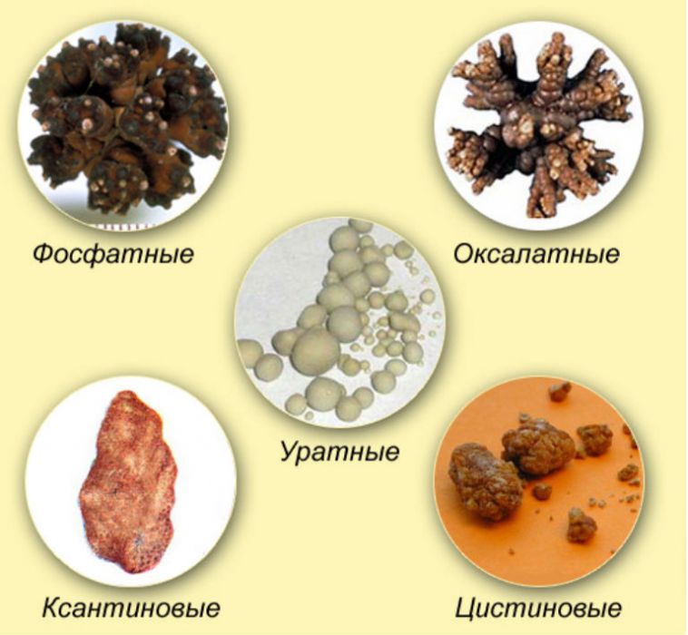 Виды камней в почках, их фото и описание, как определить состав камня