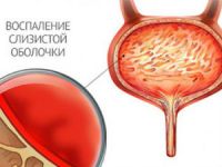 Монурал при цистите: отзывы и инструкция по применению порошка и таблеток