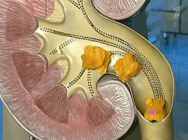 Диета при камнях в почках: питание при мочекаменной болезни (меню)