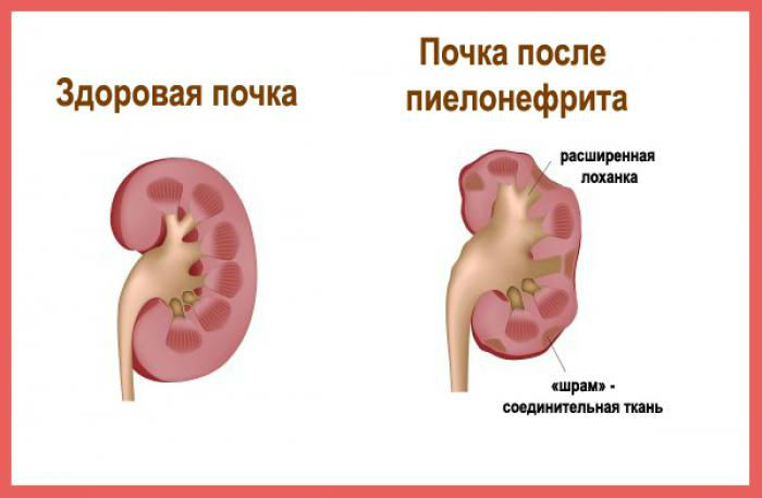Пшено для лечения почек: старинный рецепт, отзывы, противопоказания
