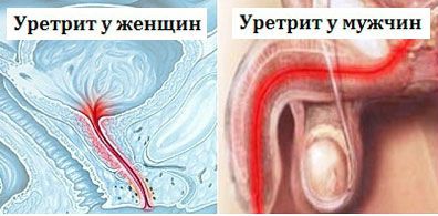 Уретрит и цистит у женщин и мужчин: лечение (антибиотики), отличия