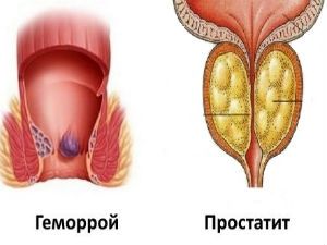 Геморрой и простатит: как отличить, причины одновременного возникновения