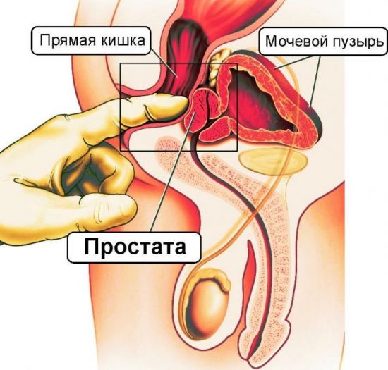 Геморрой и простатит: как отличить, причины одновременного возникновения