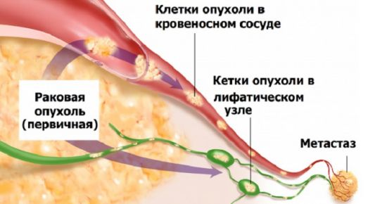 Рабдомиосаркома мочевого пузыря у детей: причины, симптомы, лечение