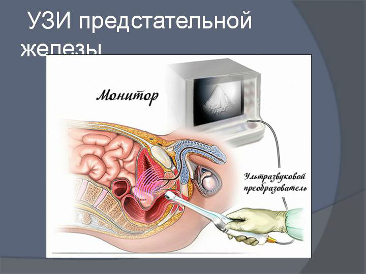 Калькулезный простатит (хронический): лечение, что это такое, самые эффективные народные средства