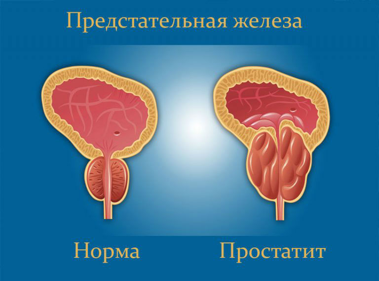 Хронический простатит: симптомы и лечение у мужчин, что это такое, признаки ремиссии, прогноз
