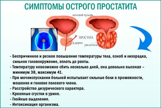 Простатит: симптомы и лечение у мужчин, что это такое, первые признаки, чем лечить