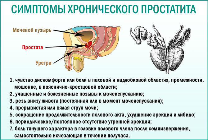 Простатит: симптомы и лечение у мужчин, что это такое, первые признаки, чем лечить