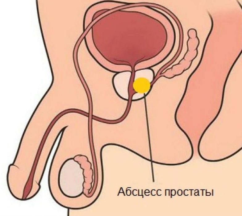 Бактериальный простатит (хронический, острый): лечение народными средствами, симптомы, причины