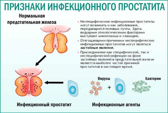 Инфекционный простатит: лечение инфекции, симптомы, причины и диагностика