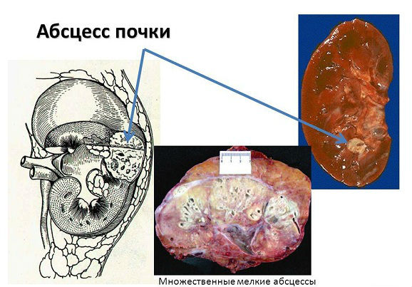 Классификация пиелонефрита и виды заболевания