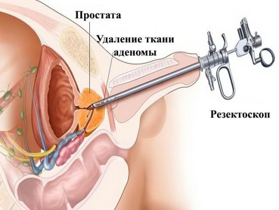 Острый простатит у мужчин: симптомы, лечение лекарствами и препаратами, последствия