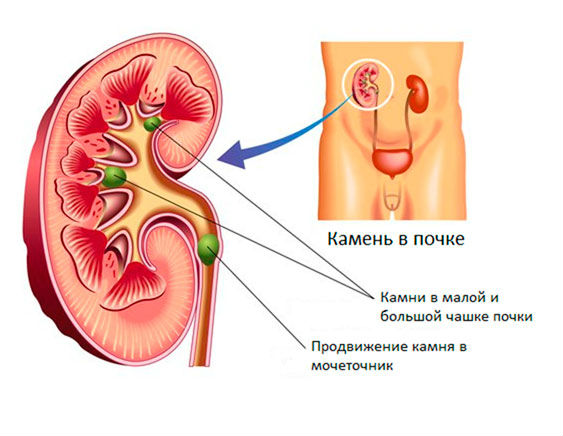 Почему после арбуза болят почки, могут ли они болеть от него