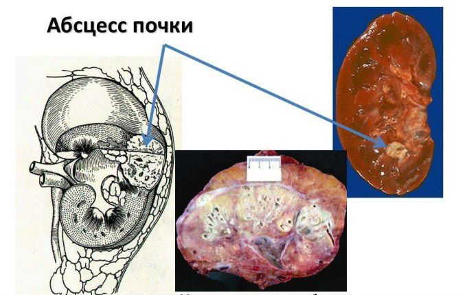 Чем опасен пиелонефрит почек и его осложнения