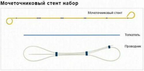 Гидроуретер: что это такое, причины, диагностика и лечение