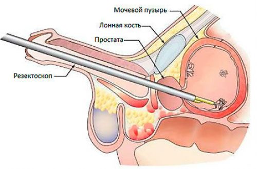 Карцинома мочевого пузыря, причины уротелиальной карницомы у мужчин