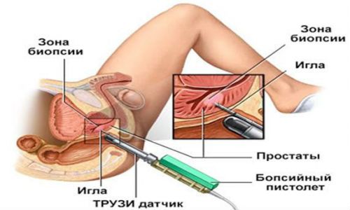Может ли аденома простаты перерасти в рак, отличия заболеваний