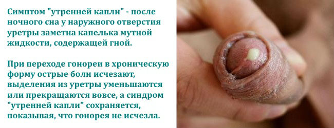 Воспаление уретры у женщин и мужчин: симптомы, лечение таблетками и препаратами