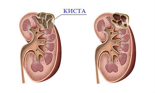 Пункция кисты почки: последствия, показания, проведение
