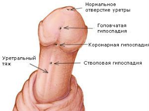 Гипоспадия у мальчиков (головчатая, стволовая, венечная и мошоночная форма)