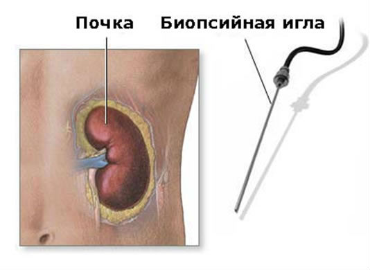 Пункция кисты почки: последствия, показания, проведение