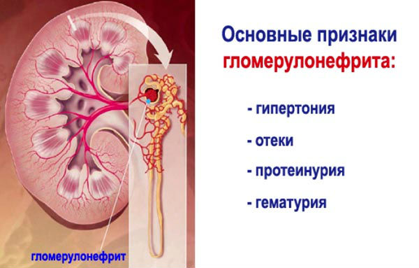 Лечение гломерулонефрита народными средствами и методами