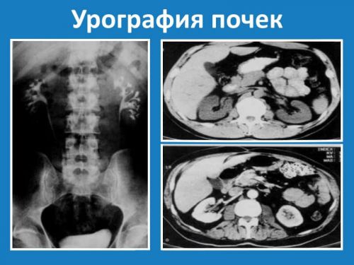 Блуждающая почка: симптомы и лечение, стадии болезни