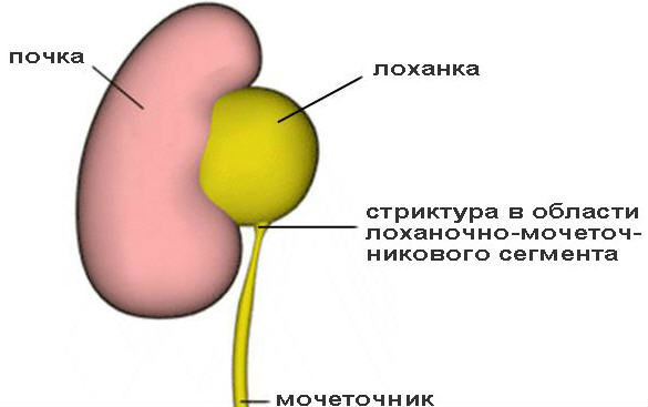Сужение мочеточника: лечение и бужирование, диагностика