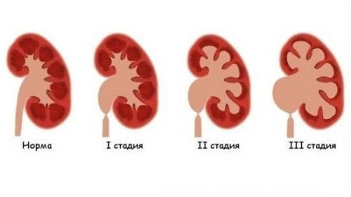 Сужение мочеточника: лечение и бужирование, диагностика