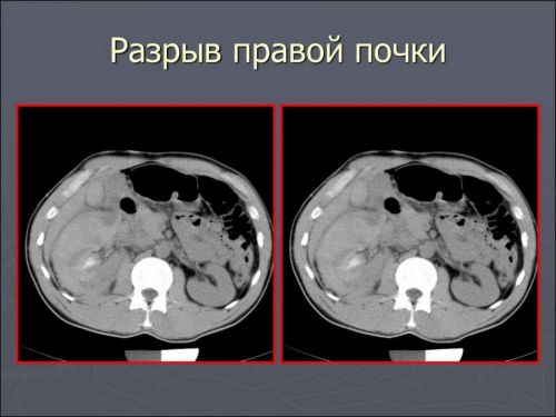 Ушиб почки при падении: лечение, симптомы и причины