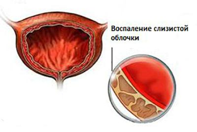Клюква и брусника при цистите: как принимать, рецепты лечения