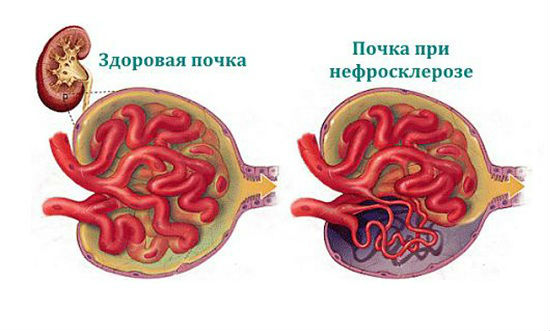 Отказ почек: симптомы, есть ли шанс выжить, если отказали почки у человека