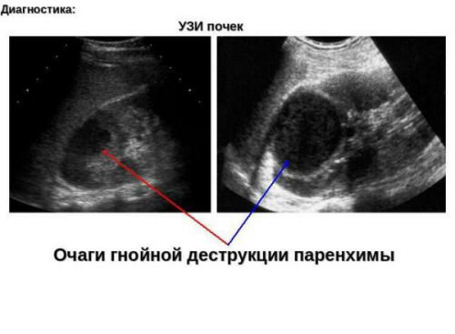 Абсцесс почки: симптомы, лечение и методы диагностики