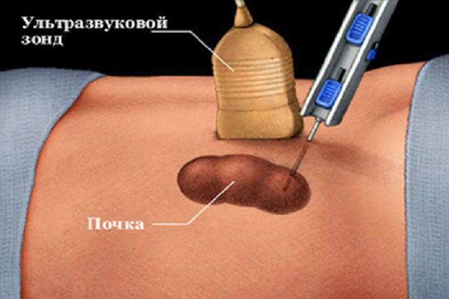 Абсцесс почки: симптомы, лечение и методы диагностики