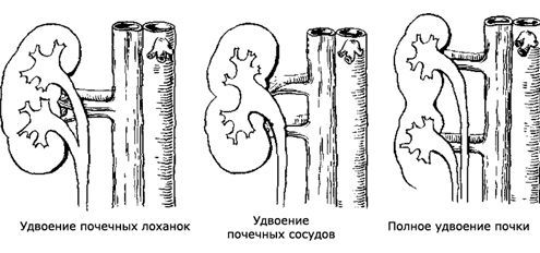 Удвоенная почка (левая или правая): что такое неполное удвоение, причины