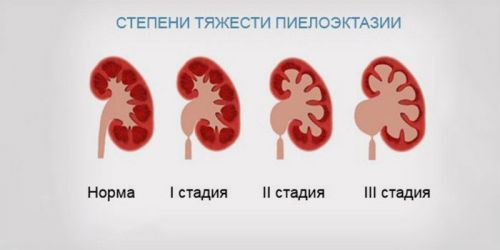 Пиелокаликоэктазия правой и левой почки: что это такое, симптомы у беременных