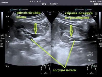 Пиелокаликоэктазия правой и левой почки: что это такое, симптомы у беременных