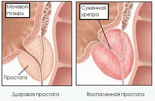 Стриктура уретры у мужчин: лечение сужения лазером