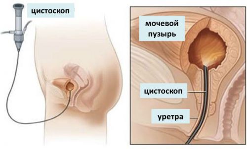 Цистит с кровью у женщин: лечение препаратами, симптомы, причины крови в моче