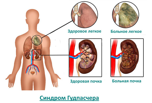 Синдром Гудпасчера: симптомы, диагностика и лечение