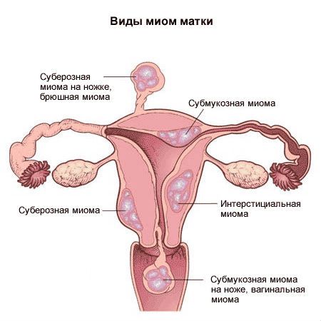 Соли в почках: симптомы и лечение, причины, как избавиться народными средствами