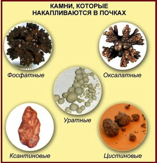 Соли в почках: симптомы и лечение, причины, как избавиться народными средствами