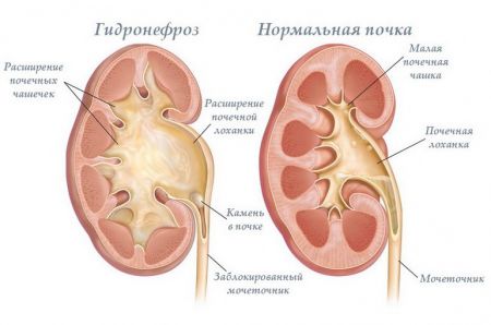 Уплотнение почек (ЧЛС, структур почечных синусов): что это такое