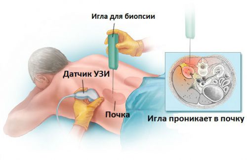 Опухоль почки: симптомы, что это такое, диагностика и лечение, прогнозы
