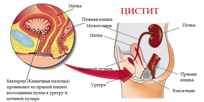 Воспаление мочевого пузыря у женщин: лечение, симптомы и причины