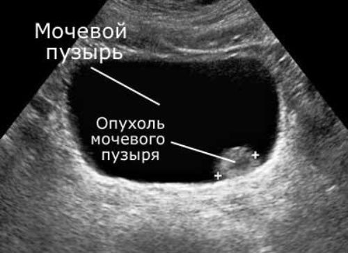 Новообразование в мочевом пузыре у женщин, объемное образование у мужчин