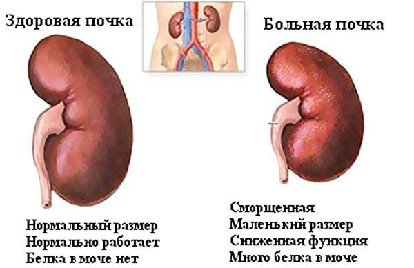 Болезни почек: симптомы и признаки, лечение, причины, список заболеваний
