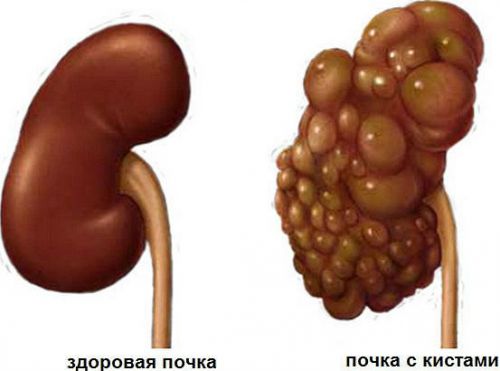 Болезни почек: симптомы и признаки, лечение, причины, список заболеваний