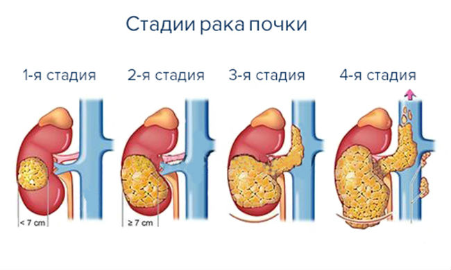 Болезни почек: симптомы и признаки, лечение, причины, список заболеваний