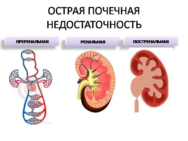 Хроническая болезнь почек: классификация заболеваний, стадии и рекомендации